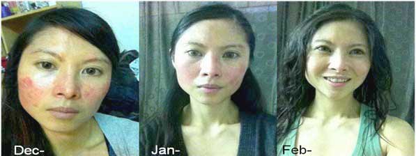 psoriasis kangen water strong acidic water