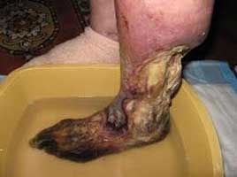 gangrene