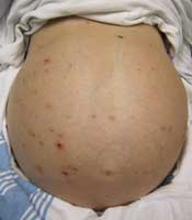 liver cirrhosis