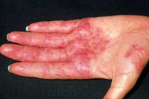 dermatitis