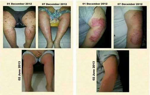 psoriasis kangen water