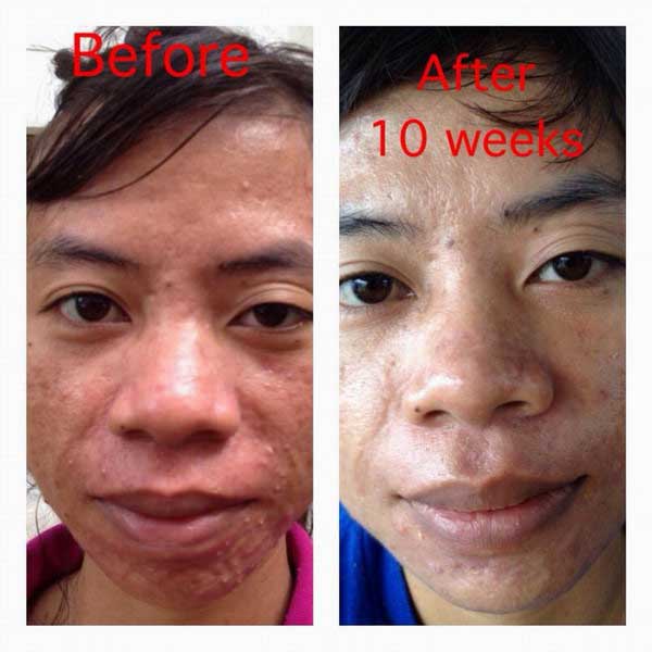 testimoni jerawat kangen water