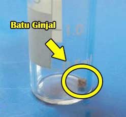 testimoni batu ginjal kangen water